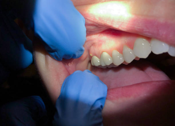 Best Emergency Dentist for Knocked-Out Tooth in Denver City, TX